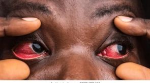 Samaritan Mission - How to Reduce Allergy