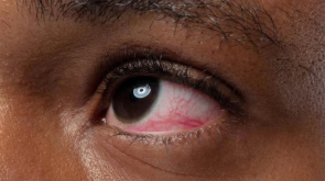 Dry Eyes